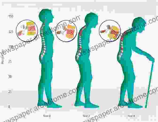 Image Of A Person With Osteoporosis The Therapy For Osteoporosis Richard Clark